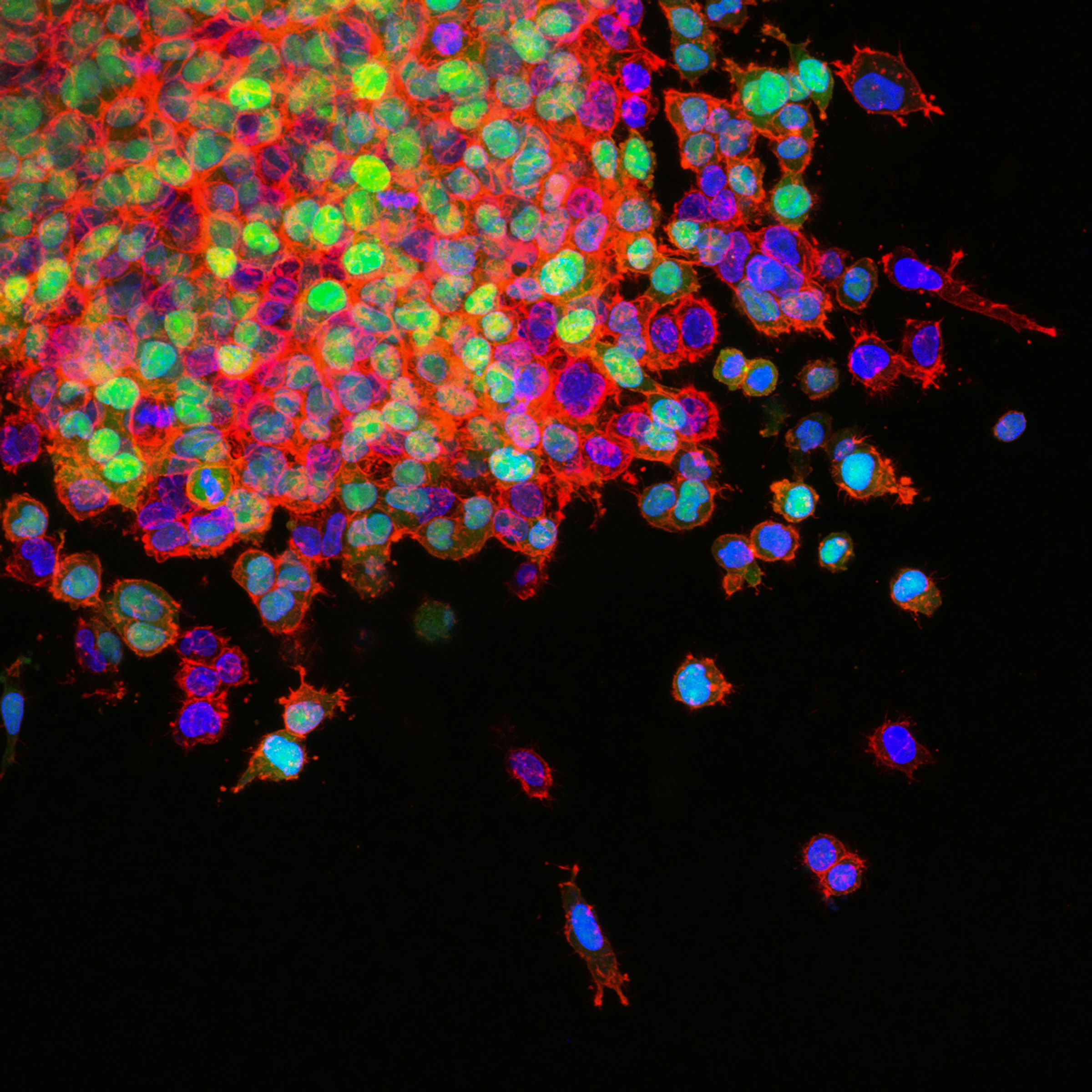 Fluorescent microscopy associated with lung cancer metastasis